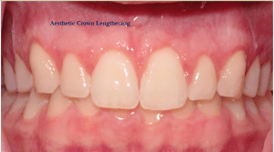 Crown lengthening full mouth picture after